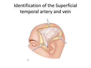 Identification of the Superficial
temporal artery and vein
C
 