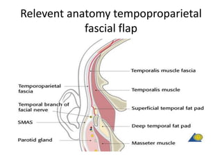 Relevent anatomy tempoproparietal
fascial flap
 