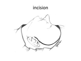 Temporalis muscle flap