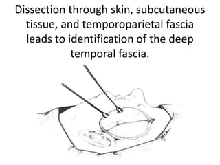 Temporalis muscle flap