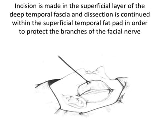 Temporalis muscle flap