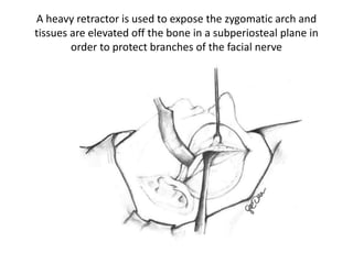 Temporalis muscle flap