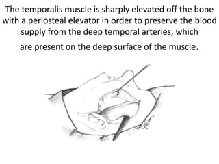 Temporalis muscle flap