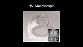 HS -Macroscopic
Source: Wiki
 