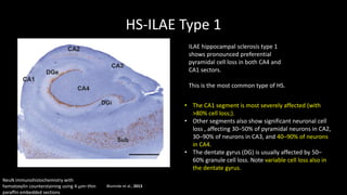 HS-ILAE Type 1
Blumcke et al., 2013
ILAE hippocampal sclerosis type 1
shows pronounced preferential
pyramidal cell loss in both CA4 and
CA1 sectors.
This is the most common type of HS.
• The CA1 segment is most severely affected (with
>80% cell loss;).
• Other segments also show significant neuronal cell
loss , affecting 30–50% of pyramidal neurons in CA2,
30–90% of neurons in CA3, and 40–90% of neurons
in CA4.
• The dentate gyrus (DG) is usually affected by 50–
60% granule cell loss. Note variable cell loss also in
the dentate gyrus.
NeuN immunohistochemistry with
hematoxylin counterstaining using 4-μm–thin
paraffin embedded sections
 