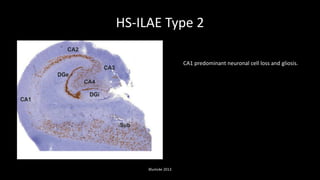 HS-ILAE Type 2
Blumcke 2013
CA1 predominant neuronal cell loss and gliosis.
 