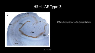 HS –ILAE Type 3
Blumcke 2013
CA4 predominant neuronal cell loss and gliosis
 