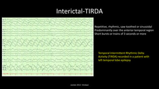 Interictal-TIRDA
Javidan 2012 -Hindwai
Repetitive, rhythmic, saw-toothed or sinusoidal
Predominantly over the anterior temporal region
Short bursts or trains of 3 seconds or more
Temporal Intermittent Rhythmic Delta
Activity (TIRDA) recorded in a patient with
left temporal lobe epilepsy
 