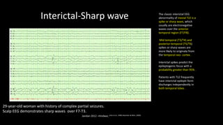 Interictal-Sharp wave
Javidan 2012 –Hindwai, erles et al., 1998; Noachtar & Rémi, 2009).
29-year-old woman with history of complex partial seizures.
Scalp EEG demonstrates sharp waves over F7-T3.
The classic interictal EEG
abnormality of mesial TLE is a
spike or sharp wave, which
usually are electronegative
waves over the anterior
temporal region (F7/F8).
Mid temporal (T3/T4) and
posterior temporal (T5/T6)
spikes or sharp waves are
more likely to originate from
the temporal neo- cortex .
Interictal spikes predict the
epileptogenic focus with a
probability greater than 95% .
Patients with TLE frequently
have interictal epilepti form
discharges independently in
both temporal lobes .
 