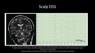 Scalp EEG
On the left: A coronal T2-weighted 3T MRI section shows reduced hippocampal volume and increased signal, consistent with left mesial
temporal sclerosis. On the right: scalp EEG recording shows interictal epileptiform activity on the left anterior temporal region
(maximum at F7 electrode).
Abundant spikes over the left temporal region, maximum at F7-T3 with spread to T5 electrode.
 