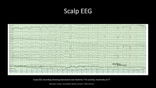 Scalp EEG
Scalp EEG recording showing lateralized ictal rhythmic 7 Hz activity, maximally at F7
Ref:Lady D. Ladino, Farzad Moien-Afshari and José F. Téllez-Zenteno
 