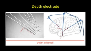 Depth electrode
 