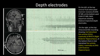 Depth electrodes On the left: at the top
coronal Fluid-attenuated
inversion recovery (FLAIR)
3T MR, at the bottom axial
FLAIR 3T MRI. Both
sequences showing
bilateral implanted depth
electrodes.
On the right: at the top
intracranial EEG recording
showing ictal lateralized
fast activity (12Hz),
maximally at RPH3-4 (Right
Posterior Hippocampus), at
the bottom there is ictal
lateralized fast activity
(16Hz), maximally at LPH3
(Left Posterior
Hippocampus).
 