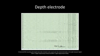Depth electrode
Intracranial EEG recording with depth electrodes showed a clear onset over the mesial electrodes in the right temporal region
RHH1-2 (Right hippocampus head) and RHB1-2 (right hippocampus body).
 