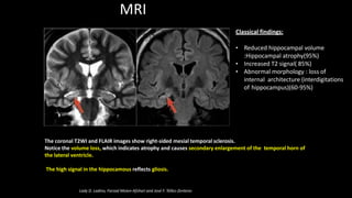 MRI
The coronal T2WI and FLAIR images show right-sided mesial temporal sclerosis.
Notice the volume loss, which indicates atrophy and causes secondary enlargement of the temporal horn of
the lateral ventricle.
The high signal in the hippocamous reflects gliosis.
Classical findings:
• Reduced hippocampal volume
:Hippocampal atrophy(95%)
• Increased T2 signal( 85%)
• Abnormal morphology : loss of
internal architecture (interdigitations
of hippocampus)(60-95%)
Lady D. Ladino, Farzad Moien-Afshari and José F. Téllez-Zenteno
 