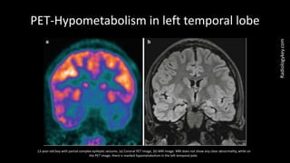 PET-Hypometabolism in left temporal lobe
13-year-old boy with partial complex epileptic seizures. (a) Coronal PET image, (b) MRI image. MRI does not show any clear abnormality, while on
the PET image, there is marked hypometabolism in the left temporal pole.
Radiologykey.com
 