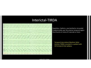 Temporal lobe epilepsy-Psychiatric aspects