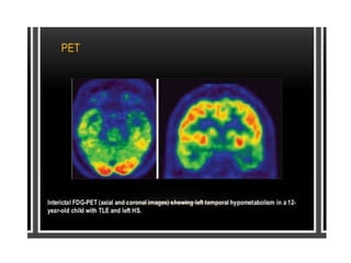 Temporal lobe epilepsy-Psychiatric aspects