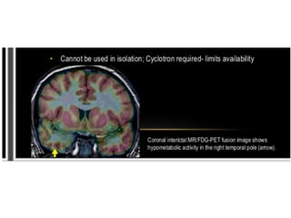 Temporal lobe epilepsy-Psychiatric aspects