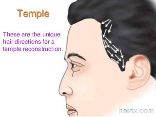 Temple
These are the unique
hair directions for a
temple reconstruction.
hairtx.com
 