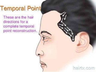 Temporal Point
These are the hair
directions for a
complete temporal
point reconstruction.
hairtx.com
 