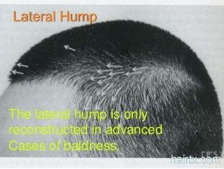 Lateral Hump
The lateral hump is only
reconstructed in advanced
Cases of baldness.
hairtx.com
 