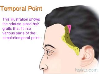 Temporal Point
This illustration shows
the relative-sized hair
grafts that fit into
various parts of the
temple/temporal point.
hairtx.com
 