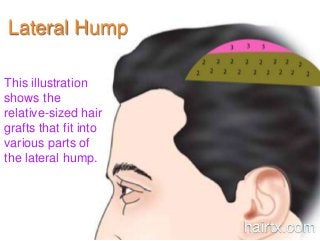 Lateral Hump
This illustration
shows the
relative-sized hair
grafts that fit into
various parts of
the lateral hump.
hairtx.com
 