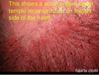 This shows a conservative upper
temple reconstruction on the left
side of the head.
hairtx.com
 