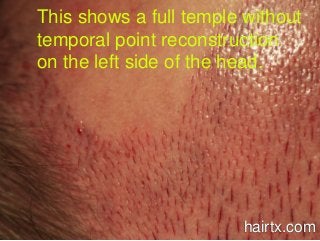 This shows a full temple without
temporal point reconstruction
on the left side of the head.
hairtx.com
 