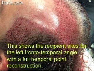 This shows the recipient sites for
the left fronto-temporal angle
with a full temporal point
reconstruction.
hairtx.com
 