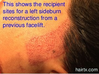This shows the recipient
sites for a left sideburn
reconstruction from a
previous facelift.
hairtx.com
 