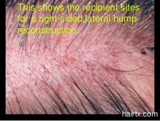 This shows the recipient sites
for a right-sided lateral hump
reconstruction.
hairtx.com
 