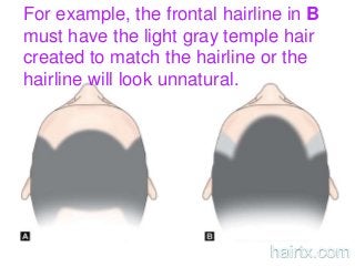 For example, the frontal hairline in B
must have the light gray temple hair
created to match the hairline or the
hairline will look unnatural.
hairtx.com
 