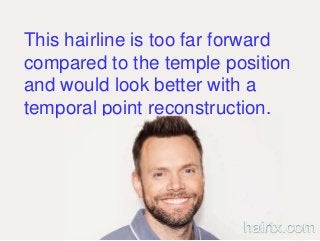 This hairline is too far forward
compared to the temple position
and would look better with a
temporal point reconstruction.
hairtx.com
 