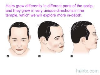 Hairs grow differently in different parts of the scalp,
and they grow in very unique directions in the
temple, which we will explore more in-depth.
hairtx.com
 
