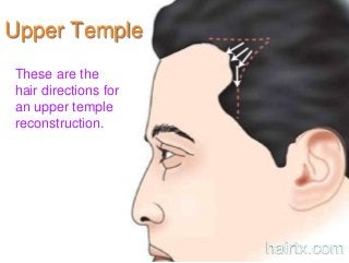 Upper Temple
These are the
hair directions for
an upper temple
reconstruction.
hairtx.com
 