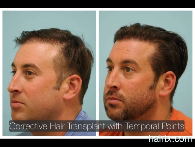 Dallas Hair Transplant Temporal Point Design