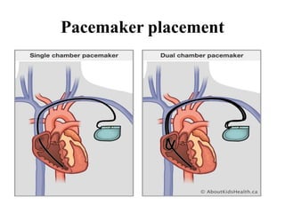 Temporary cardiac pacing | PPTX