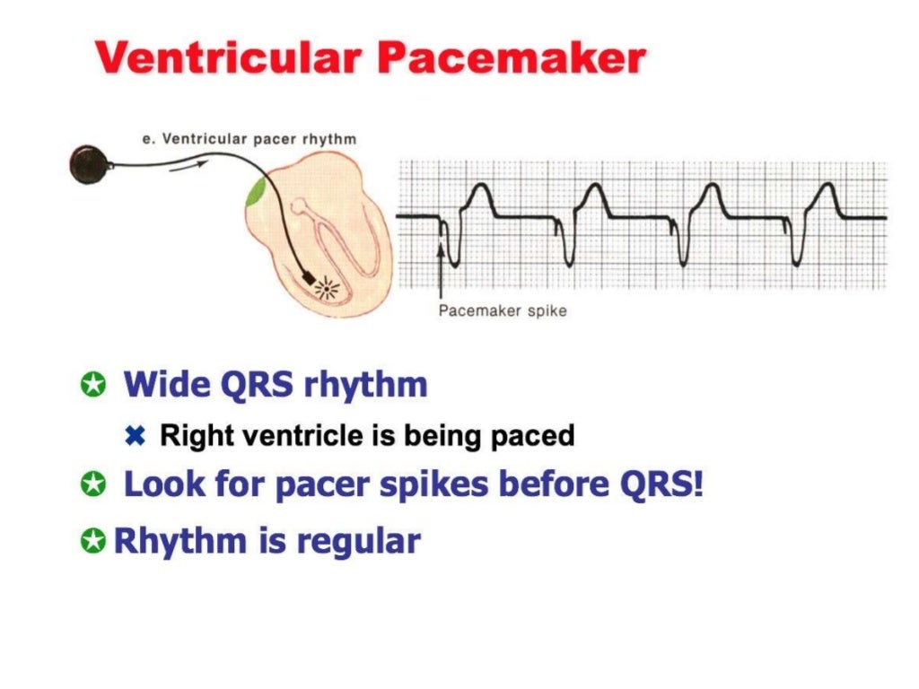 Temporary cardiac pacing