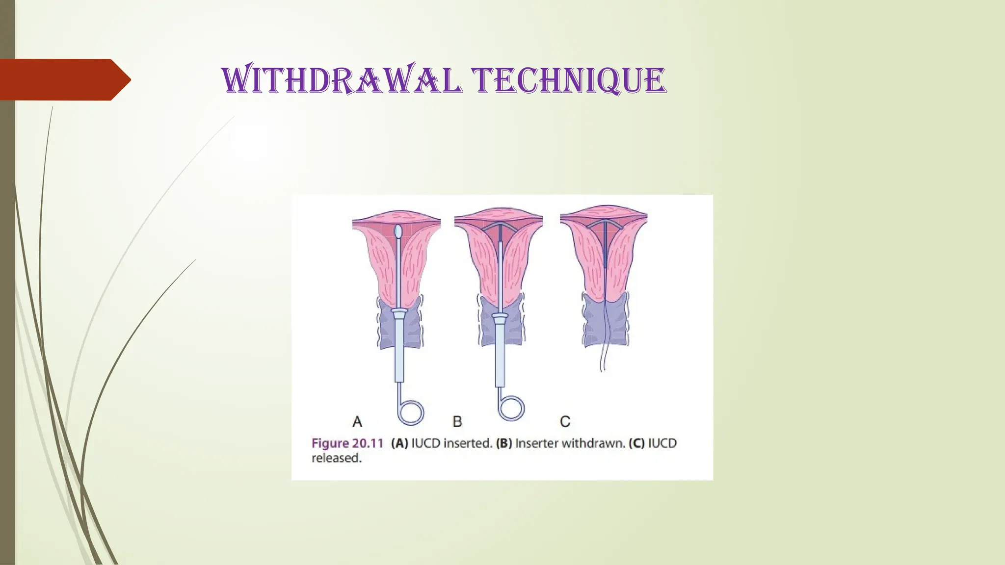 WITHDRAWAL TECHNIQUE
 