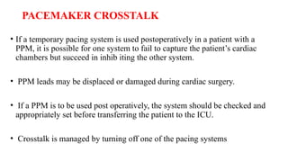 Ptpm Pacemaker temporary epicardial pacing in cardiac surgery.pptx