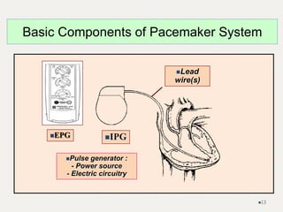 Pulse generator :
- Power source
- Electric circuitry
Lead
wire(s)
Basic Components of Pacemaker System
IPG
EPG
13
 