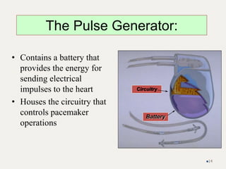• Contains a battery that
provides the energy for
sending electrical
impulses to the heart
• Houses the circuitry that
controls pacemaker
operations
Circuitry
Battery
The Pulse Generator:
14
 