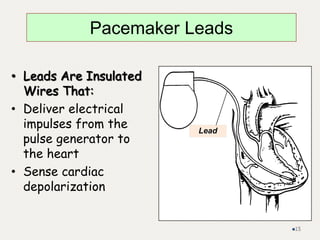 • Leads Are Insulated
Wires That:
• Deliver electrical
impulses from the
pulse generator to
the heart
• Sense cardiac
depolarization
Lead
Pacemaker Leads
15
 