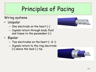 Principles of Pacing
Wiring systems
• Unipolar
– One electrode on the heart (-)
– Signals return through body fluid
and tissue to the pacemaker (+)
• Bipolar
– Two electrodes on the heart (- & +)
– Signals return to the ring electrode
(+) above the lead (-) tip.
16
 