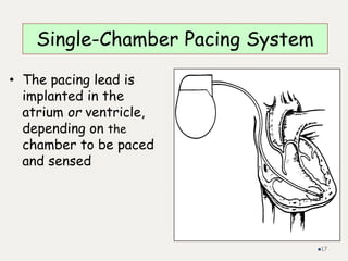 Single-Chamber Pacing System
• The pacing lead is
implanted in the
atrium or ventricle,
depending on the
chamber to be paced
and sensed
17
 