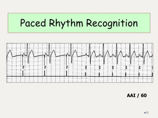 Paced Rhythm Recognition
AAI / 60
18
 