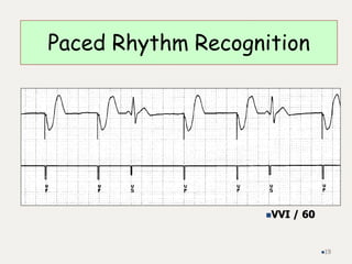 Paced Rhythm Recognition
VVI / 60
19
 