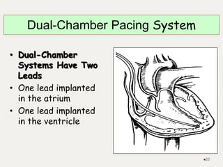 • Dual-Chamber
Systems Have Two
Leads
• One lead implanted
in the atrium
• One lead implanted
in the ventricle
Dual-Chamber Pacing System
20
 